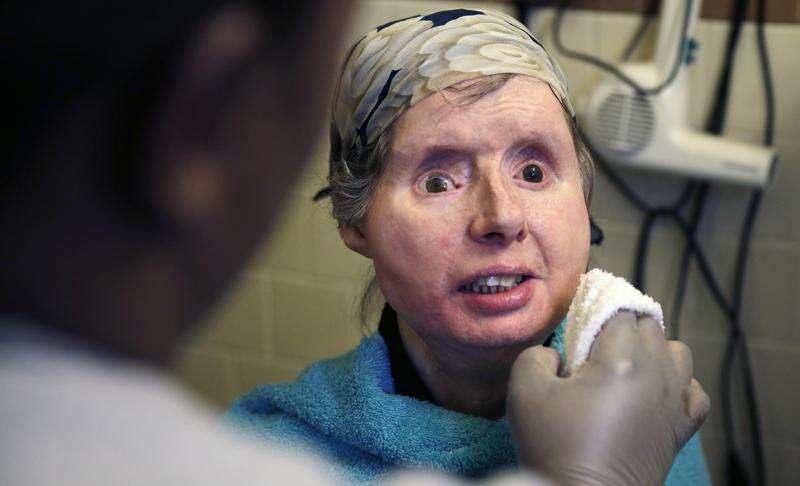 Chimp Victim S Body Rejecting Face Transplant